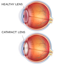 Cataract Comparison
